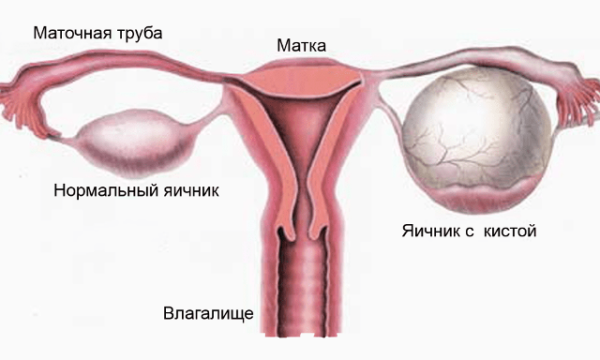 Хронический вагинит — причины, симптомы, диагностика, лечение
