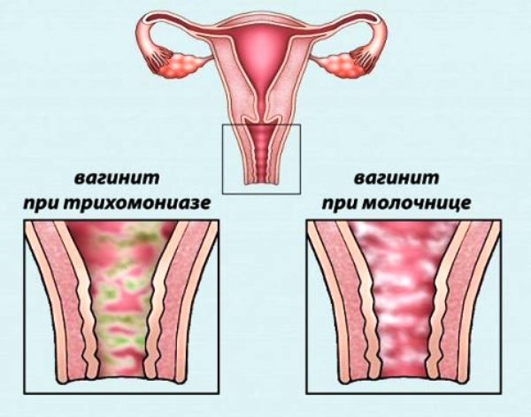 Хронический вагинит - причины, симптомы, диагностика, лечение